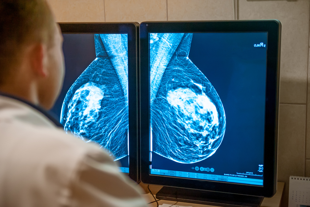 AI is better at predicting breast cancer risk than density monitoring