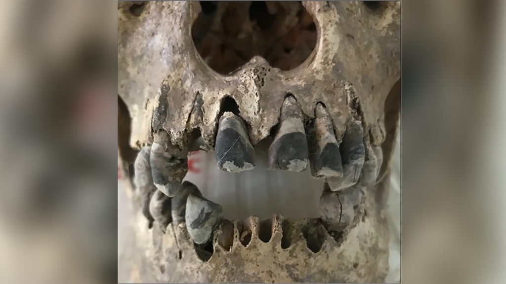 A 2,000-year-old skull reveals ancient Vietnamese people permanently blackened their teeth – a stylish habit that continues today
